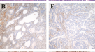 endometrial cancer research paper endometrial cancer research paper