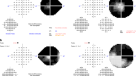 Congenital glaucoma as a presenting feature of Rubinstein-Taybi