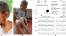 Expanding the phenotype associated to KMT2A variants: overlapping clinical  signs between Wiedemann–Steiner and Rubinstein–Taybi syndromes