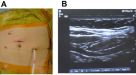 Perineal nerve block versus periprostatic block for patients undergoing  transperineal prostate biopsy (APROPOS): a prospective, multicentre,  randomised controlled study - eClinicalMedicine