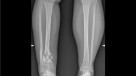 Analysis of bone transport for ankle arthrodesis as a limb salvage  procedure for the treatment of septic pilon fracture nonunion