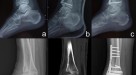 Analysis of bone transport for ankle arthrodesis as a limb salvage  procedure for the treatment of septic pilon fracture nonunion