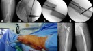 The outcomes of Ilizarov treatment in aseptic nonunions of the tibia  stratified by treatment strategies and surgical techniques