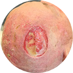 Knochen anfräsen, Dermisersatz (DRT), zeitversetzt Hauttransplantation