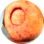 Transpositionslappen & Hauttransplantation auf Hebedefekt