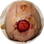 Gallealappen & Hauttransplantation