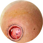 Rotationslappen, bds. bei einem Defekt