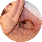 Dehnungsplastik, retroaurikulär