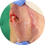 Rotationslappen, retroaurikulär