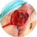 Sekundäre Wundheilung