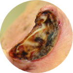 temp.gestielter Lappen, von retroaurikulär