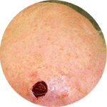 Dehnungsplastik mit Galeotomie