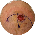 Rotationslappen von beiden Seiten bei einem Defekt