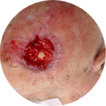 Knochen anfräsen, Dermisersatzpräparat, direkt Spalthauttransplantation