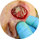 Sekundäre Wundheilung