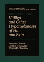 Vitiligo and Other Hypomelanoses of Hair and Skin | SpringerLink