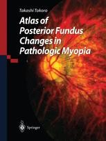 Atlas of Posterior Fundus Changes in Pathologic Myopia [ハードカバー] Tokoro， Takashi Atlas of Posterior Fundus Changes in Pathologic Myopia | Springer