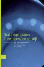 Orale Implantaten In De Algemene Praktijk | SpringerLink