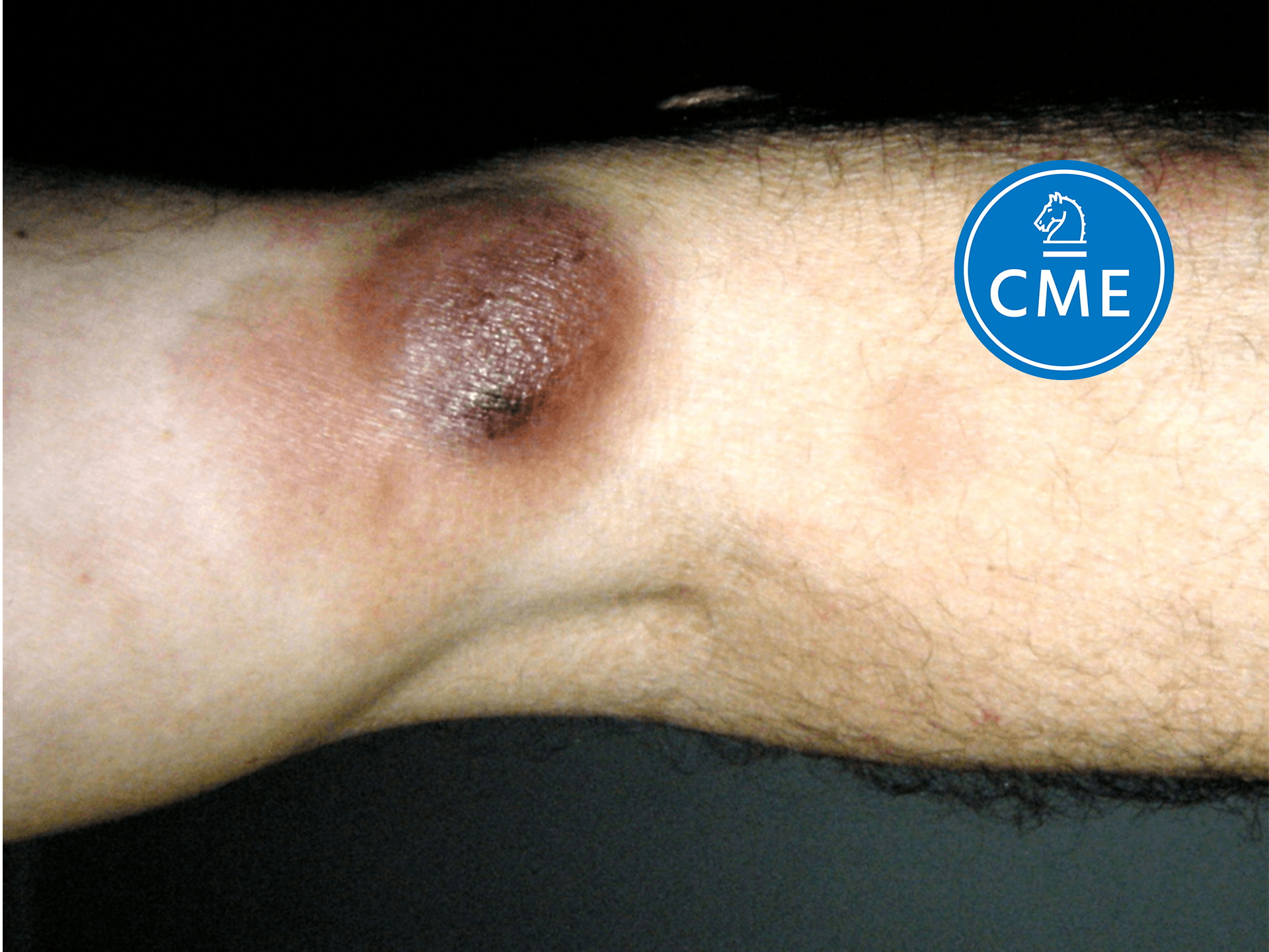 An arm with mycosis fungoides. A big dark red lump. A form of skin lymphoma. Abbreviated MF. Malignant cells in the skin that grow slowly.