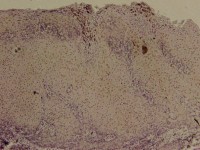 Immunohistochemical staining of IL-1β in paraffin-embedded early-stage squamous cell carcinoma of the tongue tissue sections