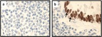 Representative staining for TTF-1 in lung tumorTumor tissue sections.