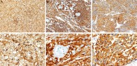 Examples of immunohistochemistry for diagnosing CNS tumors.
