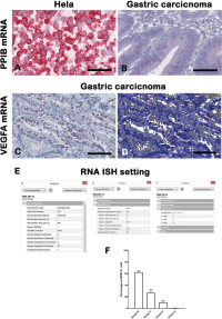 RNAscopeRNAscope assay for VEGF-A mRNA expression in human gastric carcinoma biopsy.