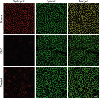 ImmunofluorescenceImmunofluorescence stainingStaining for dystrophin and and a therapeutically restored (exon-skipped) shorter dystrophin protein Microdystrophin .