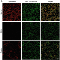 ImmunofluorescenceImmunofluorescence stainingStaining for dystrophin and beta sarcoglycan.