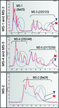 Example of an electropherogram of microsatellites showing different microsatellite patterns in the tumor vs.