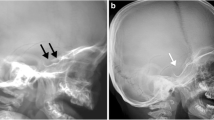 Mps Radiology Imaging findings of mucopolysaccharidoses: a pictorial review ...