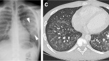 E-cigarette or vaping product use-associated lung injury in the pediatric  population: imaging features at presentation and short-term follow-up |  Pediatric Radiology