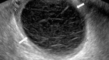 schematic representation of ectopic pregnancy