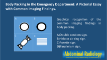 Imaging of drug mules | Emergency Radiology | Springer Nature Link
