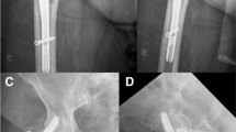 Comparison of true blood loss between short and long cephalomedullary ...