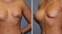 medical tourism breast reduction