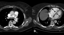 CIRSE Standards of Practice on Endovascular Treatment of Acute ...