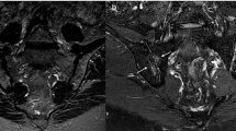 Clinical and MRI remission in axial spondyloarthritis: one-year ...