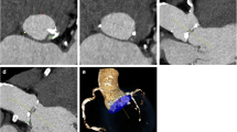 Reduction of contrast medium for transcatheter aortic valve