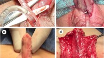 Factors affecting the outcome of foreskin reconstruction in hypospadias  surgery.