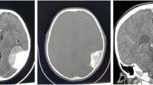 melanotic progonoma Melanotic progonoma of the skull in infancy | Child's Nervous System