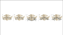 One-way self-expanding rods for early onset neuromuscular scoliosis: a ...