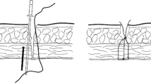 Neoclose Safety and Efficacy of Trocar Port-Site Closure Using a Biological Plug ...