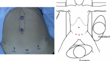 Diastasis Recti and Other Midline Defects: Totally Subcutaneous Endoscopic  Approach
