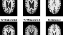 research paper alzheimer's disease