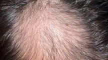 glutathione alopecia areata ** Another success story for this sufferer of alopecia areata. This patient required only 4 sessions of injections of steroid (triamcinolone) into the scalp, to achieve full Glutathione Injections For Androgenic Alopecia