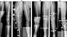 Ipsilateral Tibia Challenges in the management of floating knee injuries in a resource ...