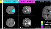 Automated Multiclass Brain Glioma Segmentation Using 3-Phase Cascaded ...