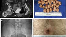 Bladder Augmentation (Enterocystoplasty): the Current State of a ...