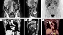 Malignant psammomatous melanotic schwannoma mimicking adrenal cyst: case report | Annals of Pediatric Surgery | Springer Nature Link Malignant psammomatous melanotic schwannoma mimicking adrenal cyst: case report | Annals of Pediatric Surgery | Springer Nature Link